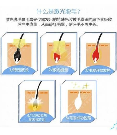 大腿激光脱毛