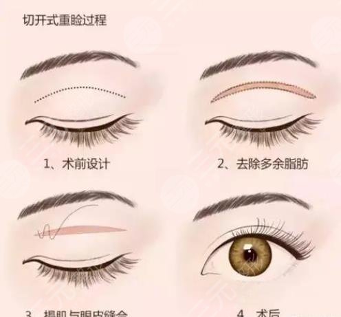 全切双眼皮