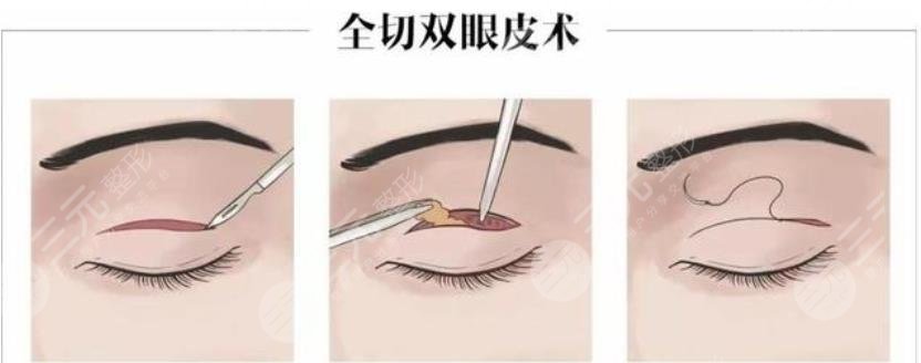 全切双眼皮