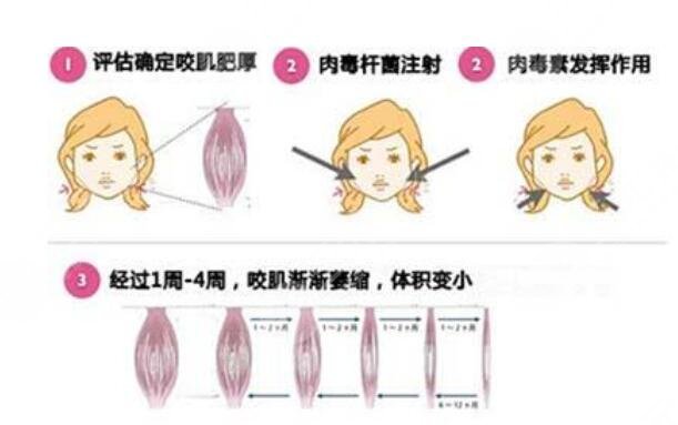注射生物注射