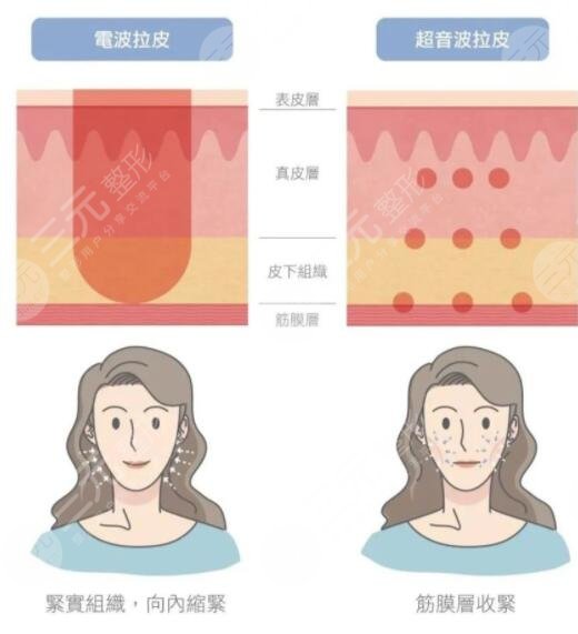 射频除皱成好吗?