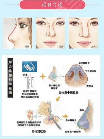 硅胶假体隆鼻