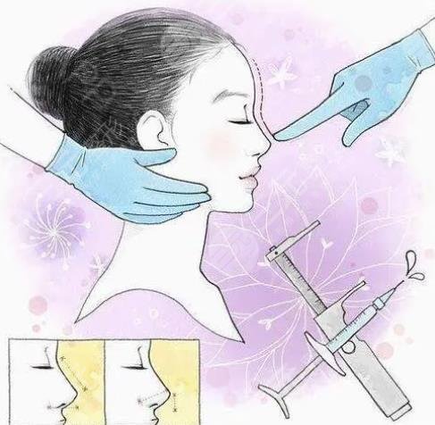 隆鼻