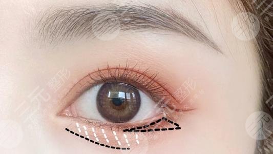 全切双眼皮加开眼角整形手术降低风险吗?