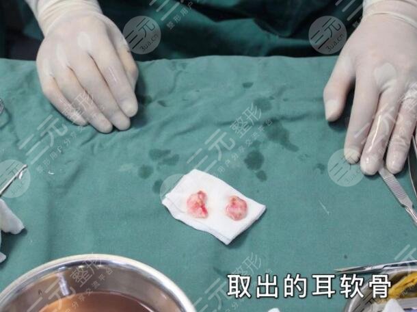 自体耳软骨垫在鼻尖的优势