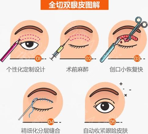 全切双眼皮