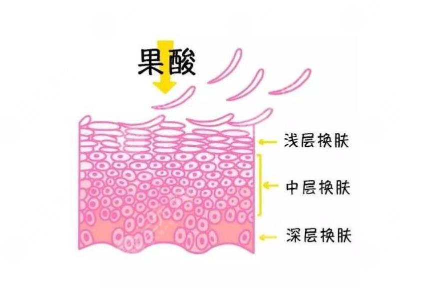 果酸换肤是什么?