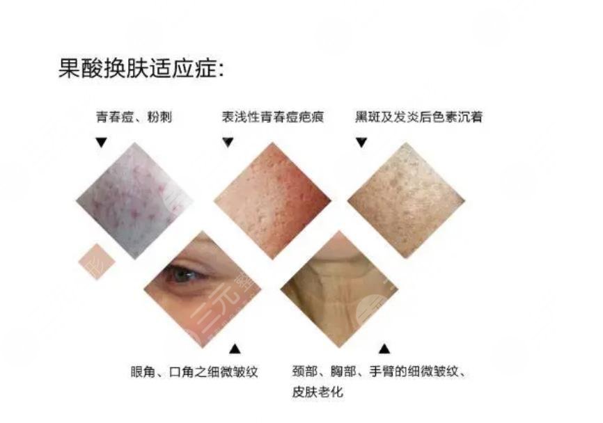 果酸换肤祛痘管用吗?果怎么样