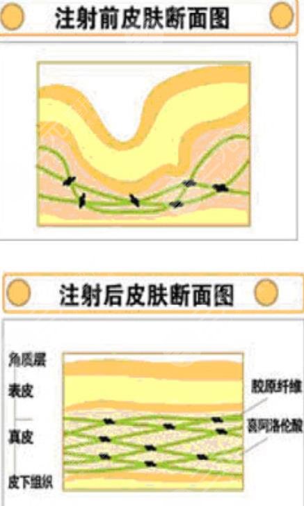 除皱