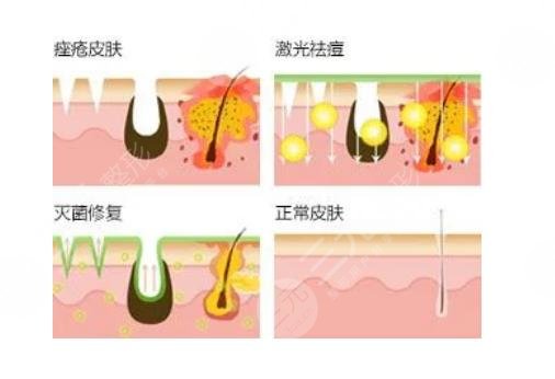 祛痘治疗方法有哪些?