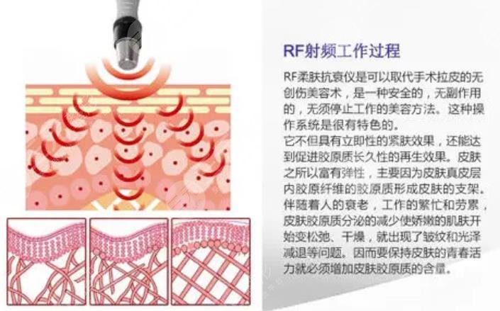 射频除皱