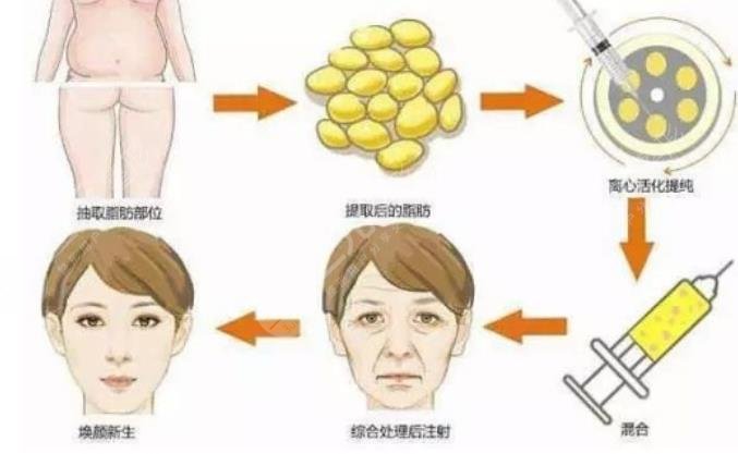 脂肪填充全脸手术好不好?