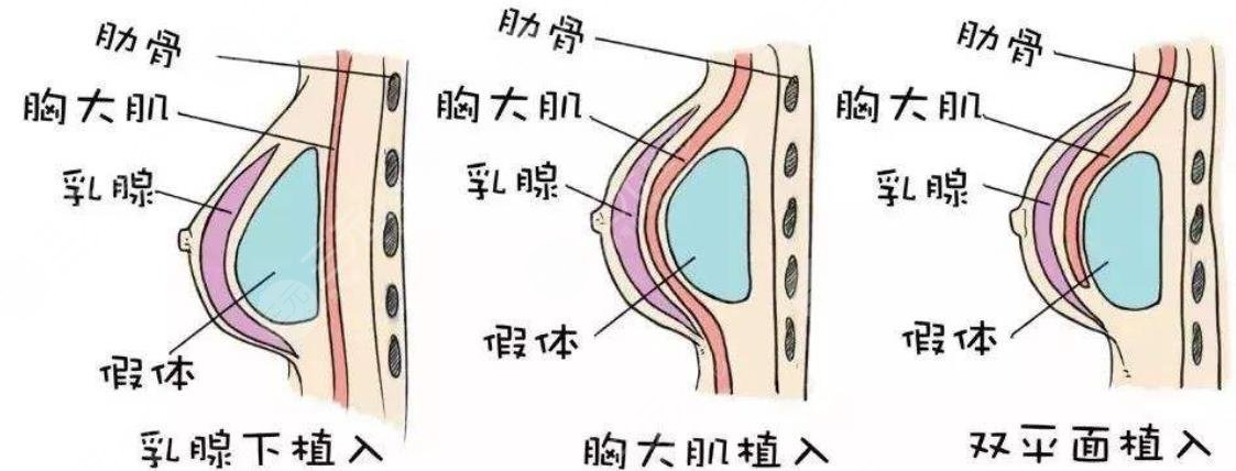隆胸手术