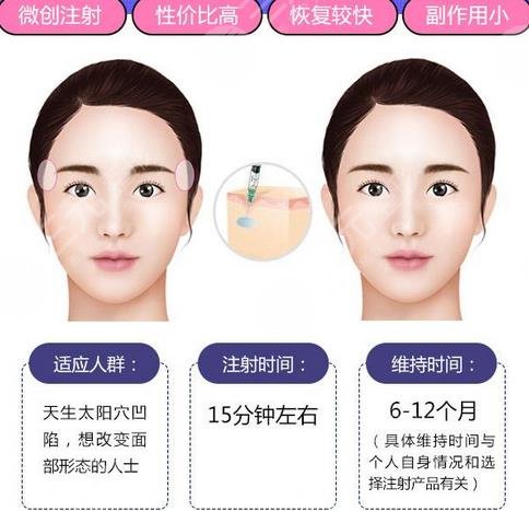 自体脂肪填充太阳穴