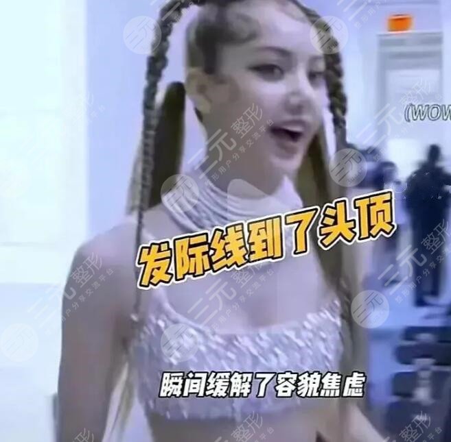 顶流爱豆Lisa脱发烦恼