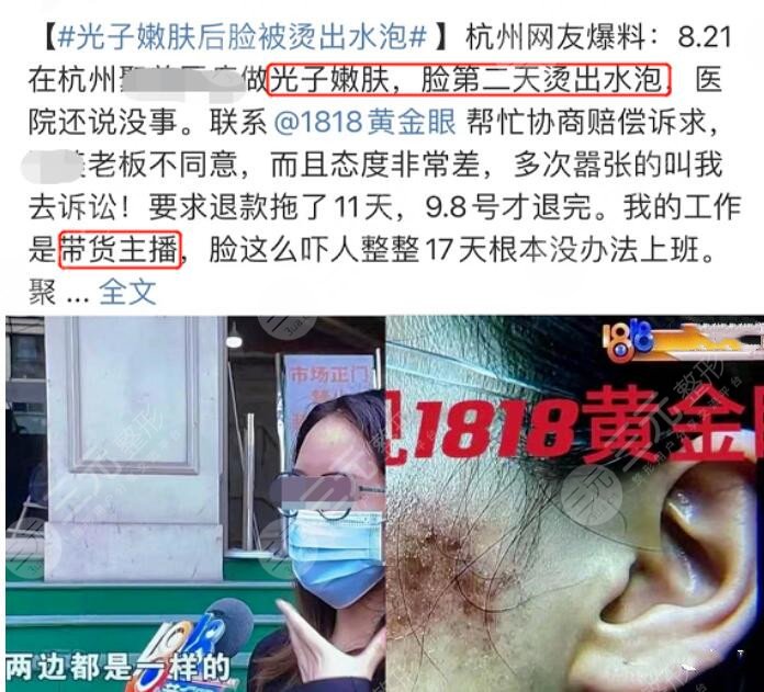 人气带货“主播”做嫩肤导致二级烫伤,原来“轻医美”也并不“轻”