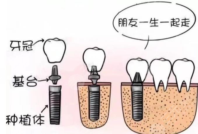 种植牙