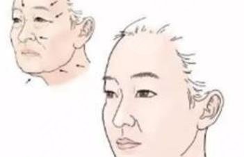 面部拉皮