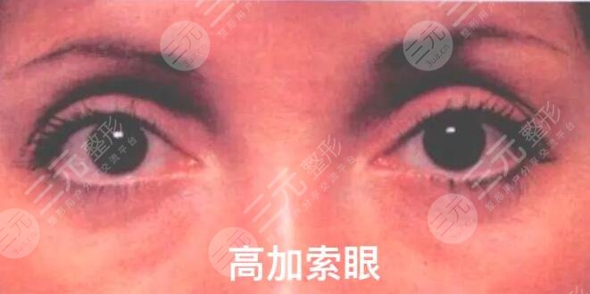 欧洲眼