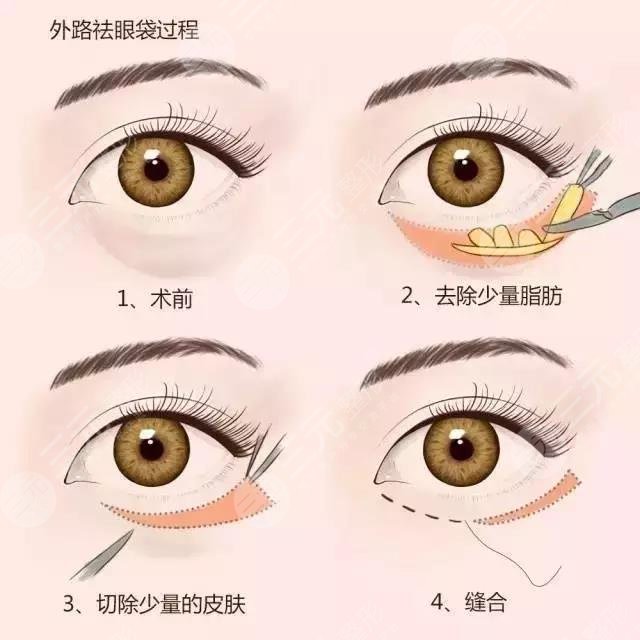 外切手术去眼袋