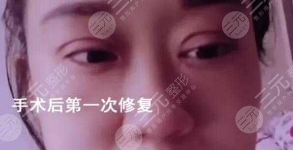 整容需谨慎！花2万割双眼皮失败，丈夫要离婚！
