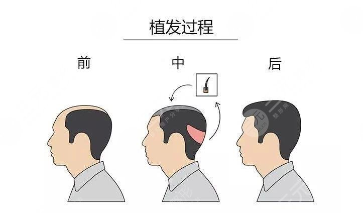 植发有什么果