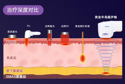 超声炮的优点