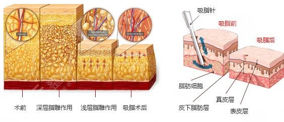 抽脂瘦腿手术有什么优势呢?