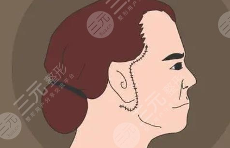 面部拉皮