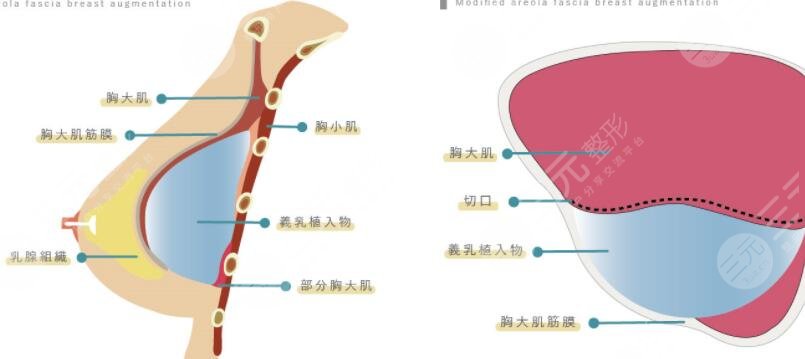 曼托水滴270隆胸成好吗