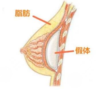硅胶隆胸能够维持多长的时间