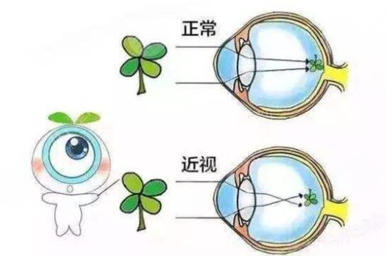 近视眼