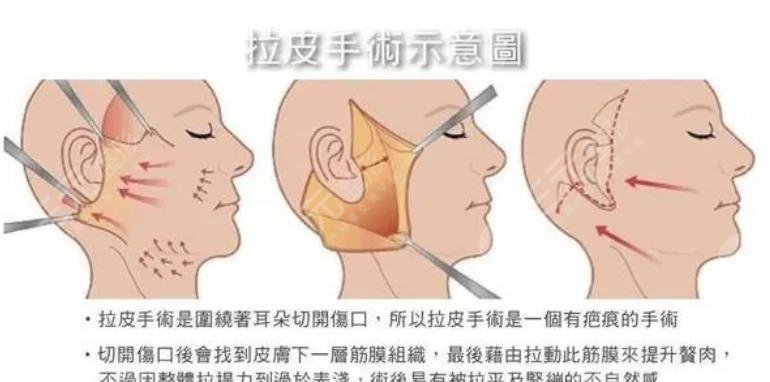 拉皮除皱美容手术
