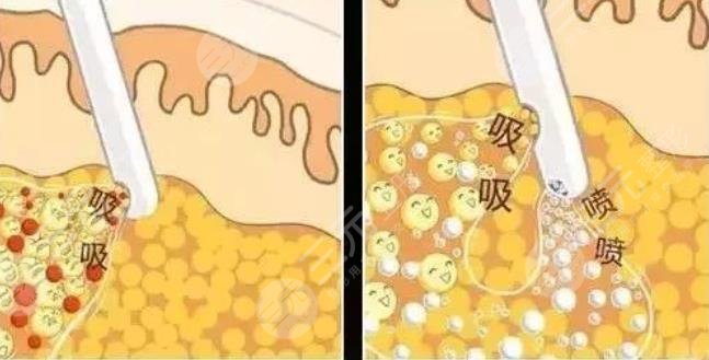 吸脂减肥手术