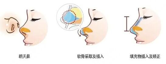 做朝天鼻矫正手术的成好吗