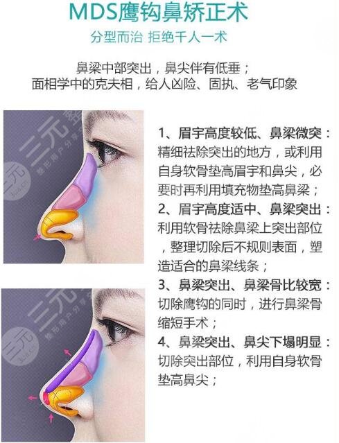 乐山达芬奇医疗美容门诊部科普鹰钩鼻整形