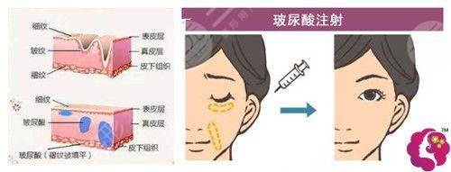 玻尿酸填充法令纹的多少钱一次