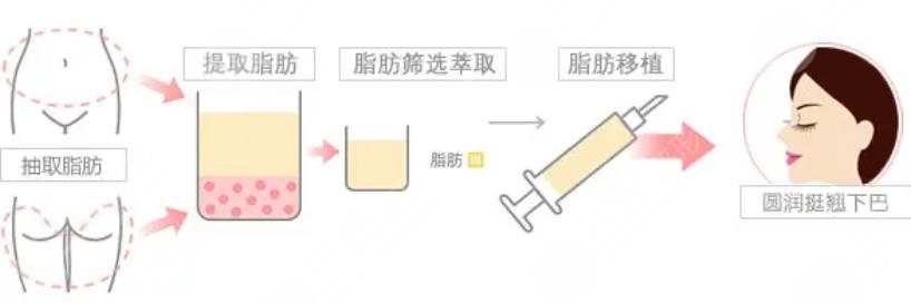 脂肪填充全脸