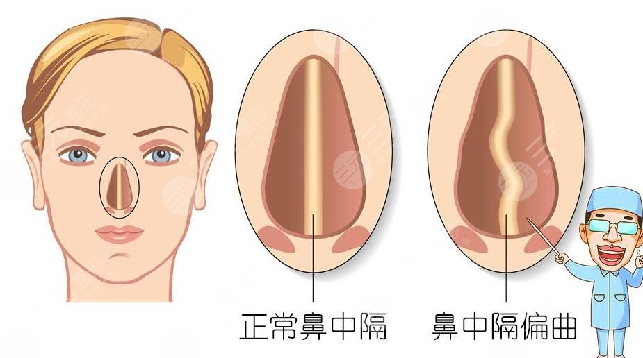 鼻修复原理