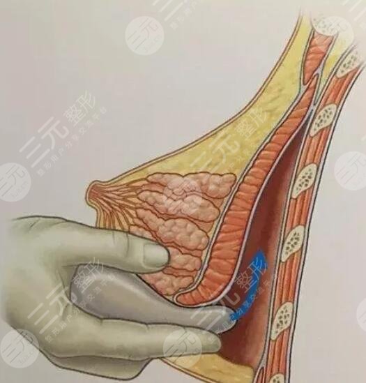 硅胶隆胸自然吗