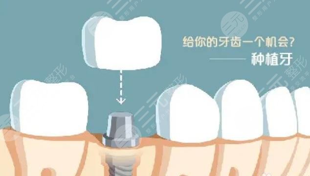 牙齿种植