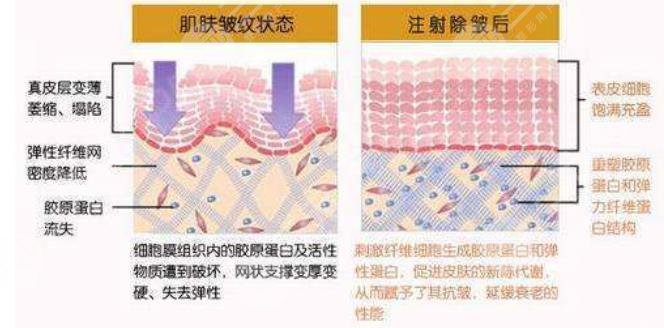 注射除皱