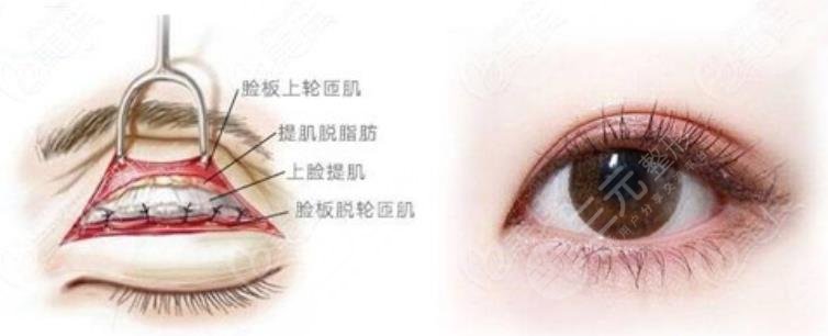 双眼皮手术是什么