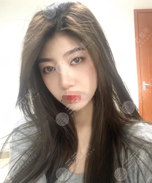 郑州赵绛波医生隆鼻术后66天