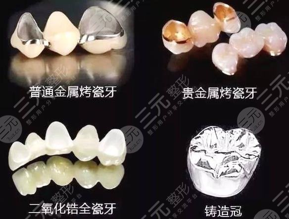 300元1颗的烤瓷牙图片怎么样?
