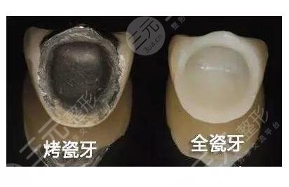 烤瓷牙和全瓷牙的区别有哪些?