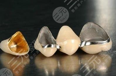 烤瓷牙和全瓷牙的区别有哪些?