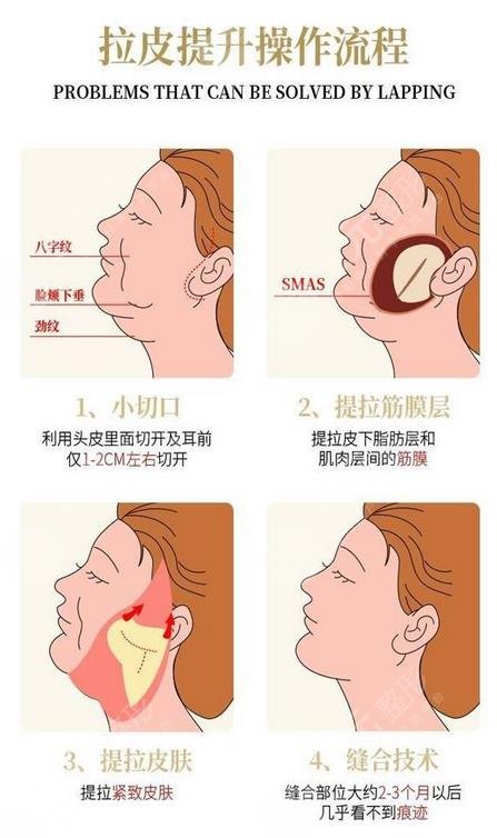 拉皮手术