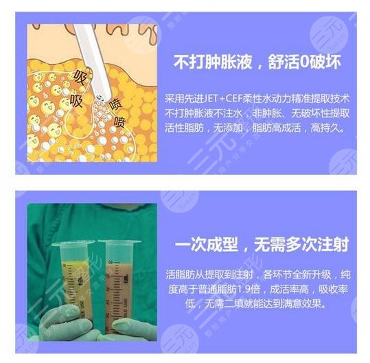 自体脂肪填充额头