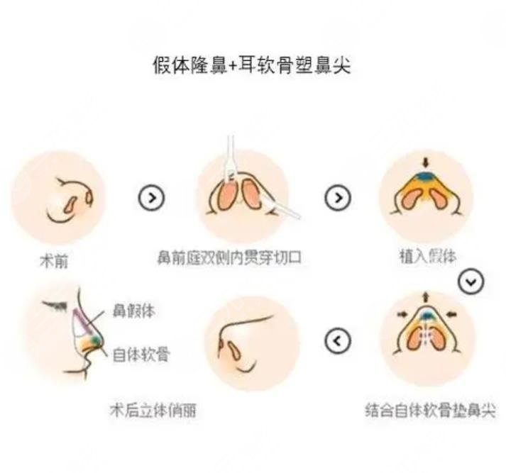 耳软骨隆鼻整形原理